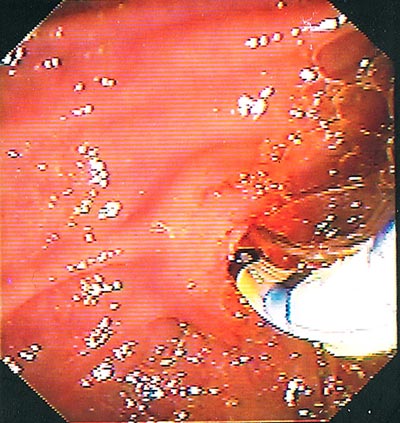 common bile duct stone. advanced in the ile duct