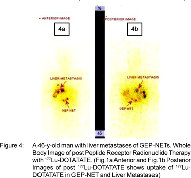 Radiolabeled somatostatin analogs for radionuclide imaging and 