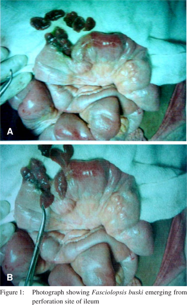 Small bowel stricture and perforation: an unusual presentation of  Fasciolopsis buski