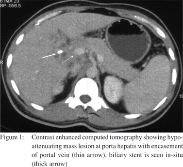 common bile duct obstruction. the common bile duct has