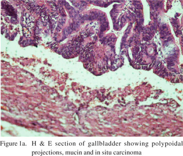 papilloma of the gallbladder)