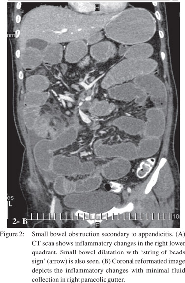 Multi detector computed tomography (MDCT) evaluation of small bowel